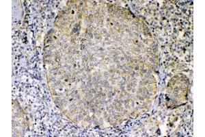IHC testing of FFPE human lung cancer tissue with TNFSF18 antibody at 1ug/ml. (TNFSF18 抗体)
