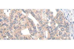 Immunohistochemistry of paraffin-embedded Human liver cancer tissue using CORO2B Polyclonal Antibody at dilution of 1:50(x200) (CORO2B 抗体)