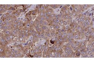 ABIN6273853 at 1/100 staining Human liver cancer tissue by IHC-P. (G Protein-Coupled Receptor 133 抗体  (Internal Region))