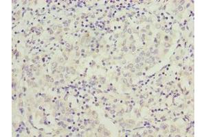 Immunohistochemistry of paraffin-embedded human lung cancer using ABIN7166922 at dilution of 1:100 (C9orf64 抗体  (AA 182-341))