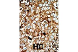 Formalin-fixed and paraffin-embedded human hepatocellular carcinoma tissue reacted with PFKFB3 polyclonal antibody  , which was peroxidase-conjugated to the secondary antibody, followed by AEC staining. (PFKFB3 抗体  (C-Term))