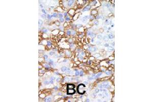 Formalin-fixed and paraffin-embedded human cancer tissue reacted with MAP4K1 polyclonal antibody  , which was peroxidase-conjugated to the secondary antibody, followed by DAB staining. (MAP4K1 抗体  (C-Term))