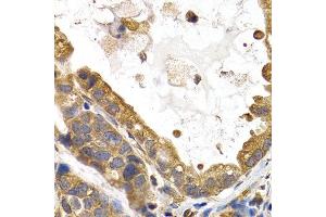 Immunohistochemistry of paraffin-embedded human stomach cancer using GYS1 antibody at dilution of 1:200 (400x lens). (Glycogen Synthase 1 抗体)