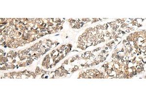 Immunohistochemistry of paraffin-embedded Human esophagus cancer tissue using CCDC181 Polyclonal Antibody at dilution of 1:50(x200) (C1orf114 抗体)