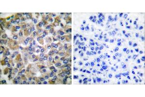 Peptide - +Immunohistochemical analysis of paraffin-embedded human breast carcinoma tissue using GRP75 antibody (#C0216). (HSPA9 抗体)