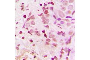 Immunohistochemical analysis of TSHZ1 staining in human breast cancer formalin fixed paraffin embedded tissue section. (TSHZ1 抗体  (C-Term))
