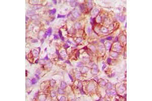 Immunohistochemical analysis of BAX staining in human lung cancer formalin fixed paraffin embedded tissue section.