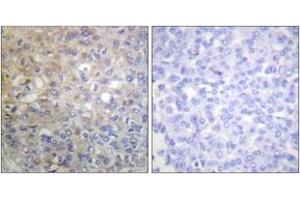 Immunohistochemistry analysis of paraffin-embedded human breast carcinoma tissue, using FGFR1 (Ab-766) Antibody. (FGFR1 抗体  (AA 736-785))