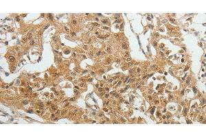 Immunohistochemistry of paraffin-embedded Human lung cancer tissue using SYT6 Polyclonal Antibody at dilution 1:40 (SYT6 抗体)