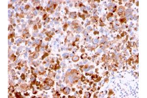 Formalin-fixed, paraffin-embedded human Melanoma stained with CD63 Mouse Monoclonal Antibody (LAMP3/2788). (CD63 抗体  (AA 100-197))