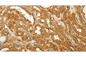 Immunohistochemistry of paraffin-embedded Human thyroid cancer tissue using RAB35 Polyclonal Antibody at dilution 1:50 (RAB35 抗体)