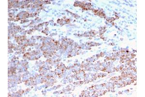 Formalin-fixed, paraffin-embedded human Colon Carcinoma stained with Cytokeratin 18 Mouse Monoclonal Antibody (rKRT18/1190). (Recombinant Cytokeratin 18 抗体)