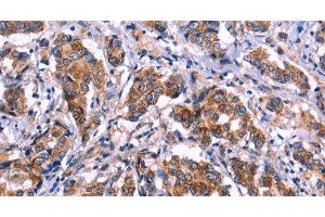 Immunohistochemistry of paraffin-embedded Human breast cancer tissue using EIF2AK4 Polyclonal Antibody at dilution 1:50 (GCN2 抗体)