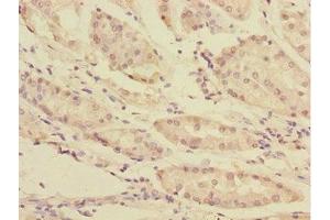 Immunohistochemistry of paraffin-embedded human gastric cancer using ABIN7166196 at dilution of 1:100 (TOB2 抗体  (AA 1-70))