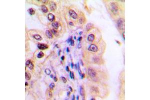 Immunohistochemical analysis of USP32 staining in human lung cancer formalin fixed paraffin embedded tissue section. (USP32 抗体  (Center))