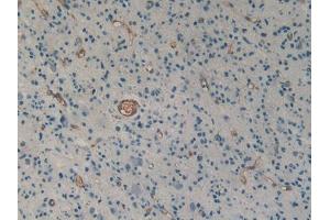 DAB staining on IHC-P; Samples: Human Glioma Tissue (Urotensin 2 抗体  (AA 20-120))