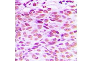 Immunohistochemical analysis of GATA4 staining in human breast cancer formalin fixed paraffin embedded tissue section.