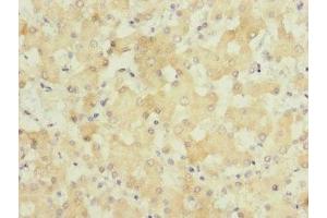 Immunohistochemistry of paraffin-embedded human liver cancer using ABIN7154045 at dilution of 1:100 (GATC 抗体  (AA 1-136))