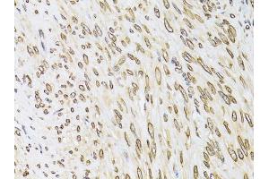 Immunohistochemistry of paraffin-embedded human uterine cancer using EMD antibody (ABIN6290347) at dilution of 1:100 (40x lens). (Emerin 抗体)