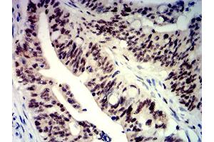 Immunohistochemical analysis of paraffin-embedded rectum cancer tissues using BTRC mouse mAb with DAB staining. (BTRC 抗体  (AA 24-151))