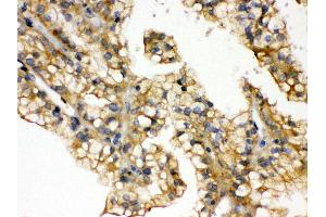 Anti- Aquaporin 2 Picoband antibody, IHC(P) IHC(P): Human Kidney Cancer Tissue (AQP2 抗体  (C-Term))