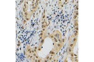 Immunohistochemical analysis of Topoisomerase 2 alpha staining in human lung cancer formalin fixed paraffin embedded tissue section. (Topoisomerase II alpha 抗体  (C-Term))