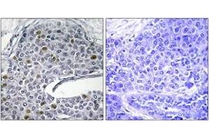 Immunohistochemistry analysis of paraffin-embedded human lung carcinoma tissue, using IRF3 (Ab-385) Antibody. (IRF3 抗体  (AA 351-400))
