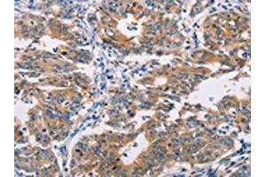 The image on the left is immunohistochemistry of paraffin-embedded Human gastic cancer tissue using ABIN7128293(AGPAT4 Antibody) at dilution 1/25, on the right is treated with fusion protein. (AGPAT4 抗体)