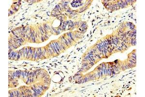 IHC image of ABIN7144916 diluted at 1:200 and staining in paraffin-embedded human colon cancer performed on a Leica BondTM system. (CCL17 抗体  (AA 559-715))