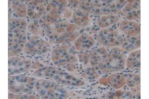 IHC-P analysis of Human Liver Cancer Tissue, with DAB staining. (COL4A1 抗体  (AA 1444-1669))