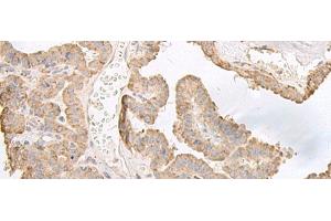 Immunohistochemistry of paraffin-embedded Human thyroid cancer tissue using PFKM Polyclonal Antibody at dilution of 1:60(x200) (PFKM 抗体)