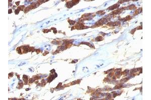 Formalin-fixed, paraffin-embedded human Thyroid Carcinoma stained with Thyroglobulin Monoclonal Antibody (SPM221). (Thyroglobulin 抗体)