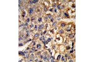 Formalin-fixed and paraffin-embedded human hepatocarcinoma reacted with 17-beta-HSD12 / HSD17B12 Antibody (Center) followed which was peroxidase-conjugated to the secondary antibody, followed by DAB staining. (HSD17B12 抗体  (Middle Region))