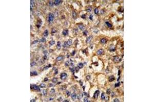 Formalin-fixed and paraffin-embedded human hepatocarcinoma reacted with 17-beta-HSD12 / HSD17B12 Antibody (Center) followed which was peroxidase-conjugated to the secondary antibody, followed by DAB staining.