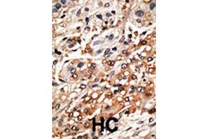 Formalin-fixed and paraffin-embedded human hepatocellular carcinoma tissue reacted with the BMF polyclonal antibody  , which was peroxidase-conjugated to the secondary antibody, followed by DAB staining. (BMF 抗体  (AA 130-150))