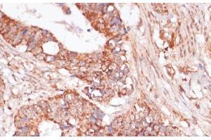 Immunohistochemistry of paraffin-embedded Human colon carcinoma using MAP2K3 Polyclonal Antibody at dilution of 1:100 (40x lens). (MAP2K3 抗体)