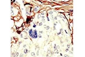 IHC analysis of FFPE human breast carcinoma tissue stained with the STK11 antibody (LKB1 抗体  (AA 387-417))