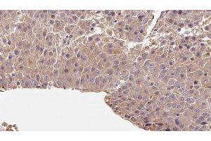ABIN6278067 at 1/100 staining Human liver cancer tissue by IHC-P. (rala 抗体  (C-Term))