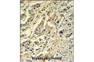 ASM3A Antibody (C-term) (ABIN651168 and ABIN2840109) IHC analysis in formalin fixed and paraffin embedded breast carcinoma followed by peroxidase conjugation of the secondary antibody and DAB staining.