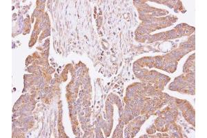 IHC-P Image Immunohistochemical analysis of paraffin-embedded human lung cancer, using C4orf19, antibody at 1:100 dilution. (C4orf19 抗体)