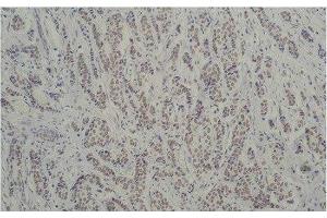 Immunohistochemistry of paraffin-embedded Human breast carcinoma tissue using TBP Monoclonal Antibody at dilution of 1:200. (TBP 抗体)