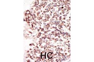 Formalin-fixed and paraffin-embedded human hepatocellular carcinoma tissue reacted with the PIM2 polyclonal antibody  , which was peroxidase-conjugated to the secondary antibody, followed by DAB staining. (PIM2 抗体  (C-Term))