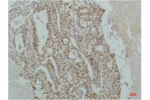 Immunohistochemical analysis of paraffin-embedded Human Lung Carcinoma using IκB β(mAb diluted at 1:200. (NFKBIB 抗体)