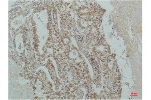 Immunohistochemical analysis of paraffin-embedded Human Lung Carcinoma using IκB β(mAb diluted at 1:200.