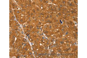 Immunohistochemistry of Human liver cancer using SSTR3 Polyclonal Antibody at dilution of 1:30