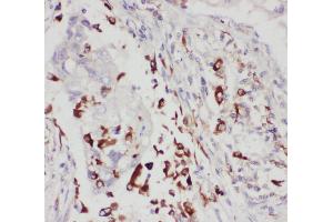 Anti-5 Lipoxygenase antibody, IHC(P) IHC(P): Human Lung Cancer Tissue (ALOX5 抗体  (C-Term))