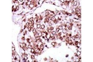 IHC analysis of FFPE human hepatocarcinoma stained with the CAMK2G antibody (CAMKII gamma 抗体  (AA 309-338))