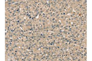 The image on the left is immunohistochemistry of paraffin-embedded Human breast cancer tissue using ABIN7192556(SMAGP Antibody) at dilution 1/40, on the right is treated with synthetic peptide. (SMAGP 抗体)