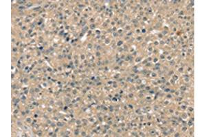 The image on the left is immunohistochemistry of paraffin-embedded Human breast cancer tissue using ABIN7192556(SMAGP Antibody) at dilution 1/40, on the right is treated with synthetic peptide.