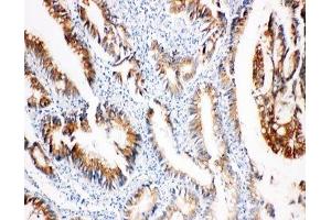 IHC-P: COX2 antibody testing of human intestinal cancer tissue (COX2 抗体  (AA 589-604))